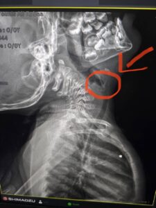 فريق طبي بسوهاج الجامعي ينجح في استخراج شوكة سمكة من القصبة الهوائية لطفل