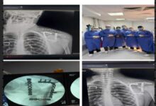 نجاح جراحة نادرة بمستشفى التأمين الصحي بالفيوم تنقذ شابًا من كسر معقد.