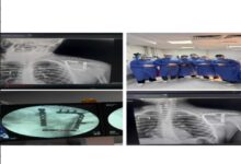 نجاح جراحة نادرة بمستشفى التأمين الصحي بالفيوم تنقذ شابًا من كسر معقد.