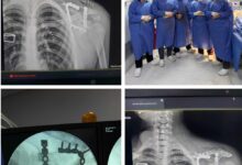 نجاح جراحة نادرة بمستشفى التأمين الصحي بالفيوم تنقذ شابًا من كسر معقد.