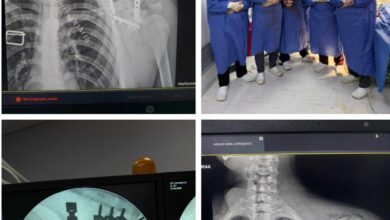 نجاح جراحة نادرة بمستشفى التأمين الصحي بالفيوم تنقذ شابًا من كسر معقد.
