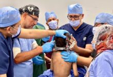 تكلفة الواحدة 480جنيها..” الكرنك الدولى بالأقصر” تجرى 3عمليات لمرضى الشلل الرعاش والديستونيا