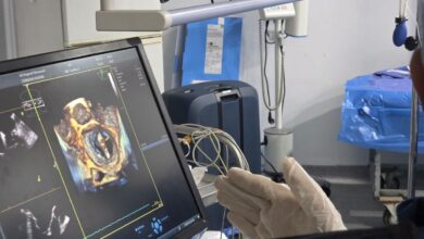 جامعة سوهاج تجري اول حالة لاصلاح الصمام الميترالي بالقسطرة
