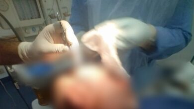 نجاح مستشفى مغاغة بالمنيا في استئصال ورم جلدي بفروة رأس مسن